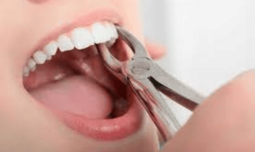 tooth extraction