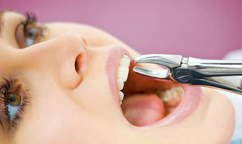 tooth extraction