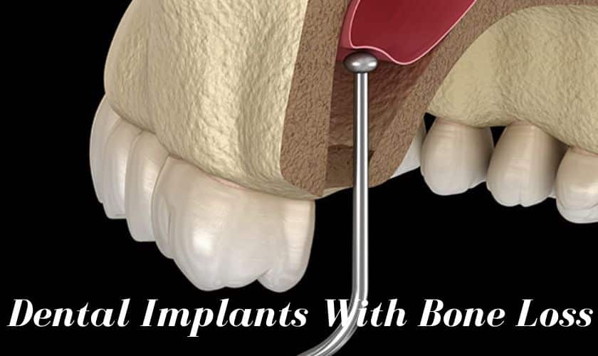 Dental-Implants-With-Bone-Loss