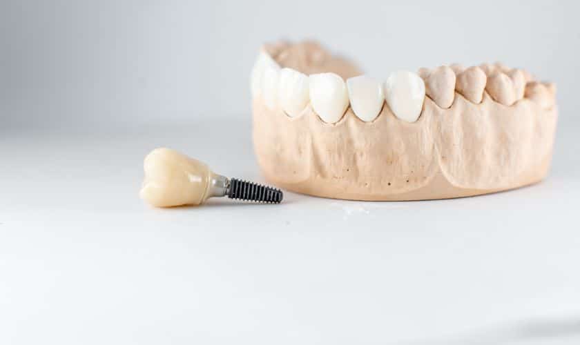 Dental-Implants