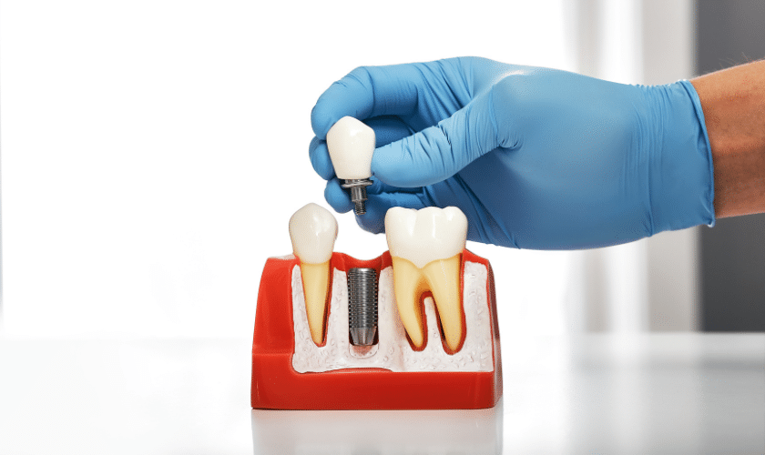 Image of Dental Implants - How To Care For Your Dental Implants: Maintenance Tips For Longevity