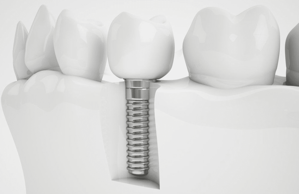 What Is The Earliest Age For A Dental Implant