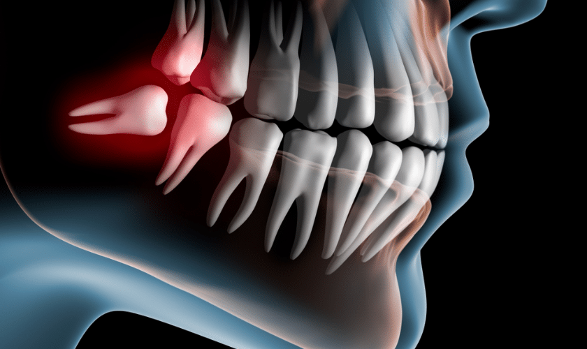 How Do I Know I Need My Wisdom Teeth Removed