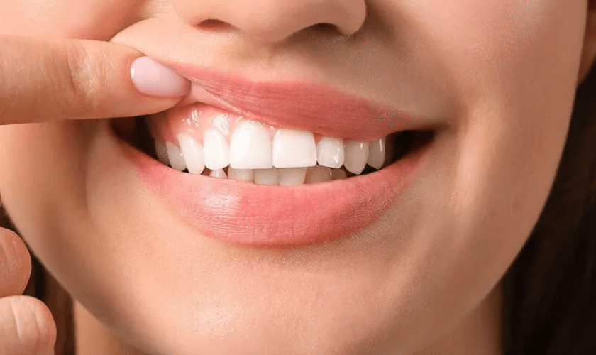 How Long Does A Gum Graft Last?