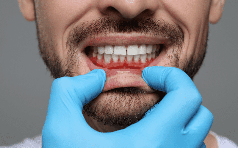 Treating Gum Disease Lower Your Risk of Heart Disease