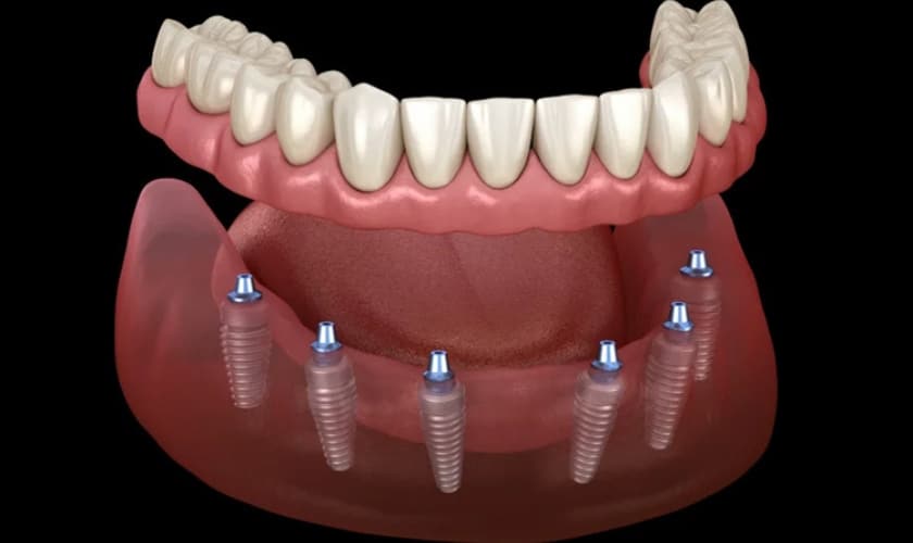 Can Dental Implants Be Removed