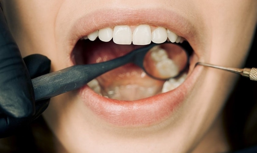 Wisdom Teeth Crowding Your Teeth Dentists Share When to Take Action